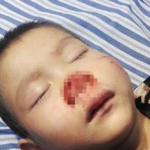 都昌一5岁男童被狗咬下鼻尖 因无钱医治 鼻梁被药水保存 希望好心人帮帮他们 ...